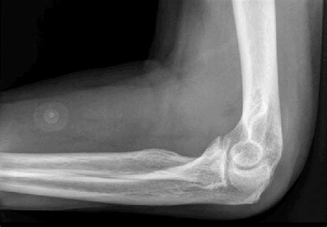 Lateral X Ray Of The Elbow Demonstrating Soft Tissue Swelling And