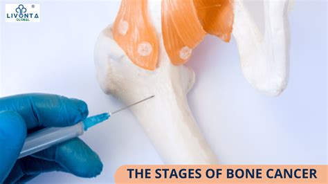 The Stages Of Bone Cancer Bone Neoplasm Livonta Global Pvt Ltd