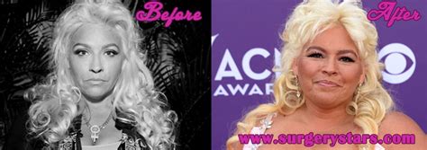 beth chapman plastic surgery before and after pic