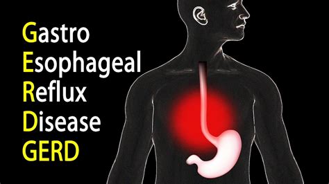 Gastro Esophageal Reflux Disease Update Vlog Style Youtube
