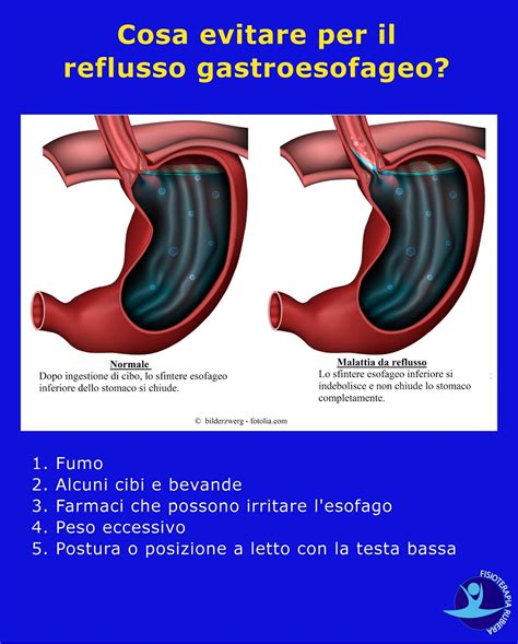 Questo sintomo del reflusso gastroesofageo si avverte quando si ha quella sensazione di amaro in alimenti da evitare. Reflusso gastroesofageo: La Vera Causa e Come Curarlo con ...