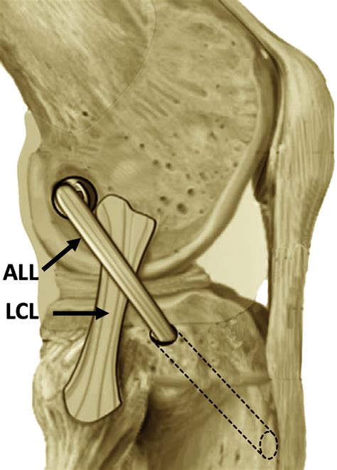 Combined Reconstruction Of The Anterolateral Ligament In Patients With