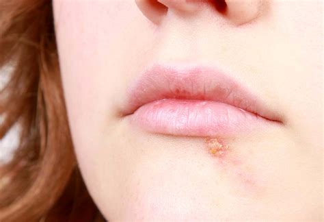 What Causes Sores On Children S Lips