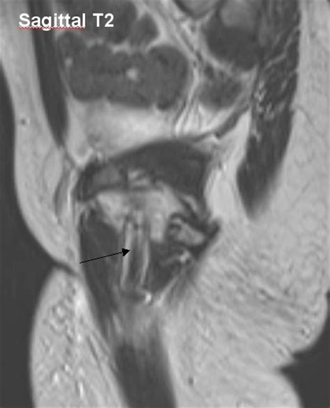 Mricases Perineal Injury Foreign Body In The Obturator Externus