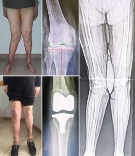 Use Of External Approach For Severe Genu Valgo Knee Arthroplasty