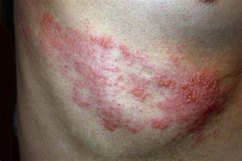 Identifying Skin Rashes Shingles
