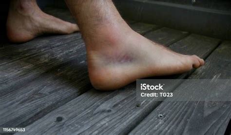 Swollen Injured Ankle After Rolling Ones Ankle Stock Photo Download