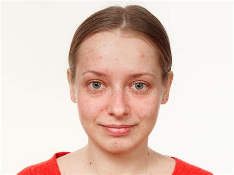 Portrait Of A Girl Without Makeup Acne On The Face On A White