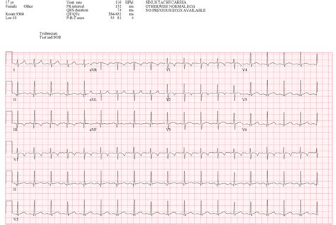 Pedi Cardiology Ekg Pulmonary Embolism Hot Sex Picture