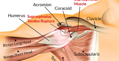 The other important anatomical structure involved in shoulder impingement is the subacromial subdeltoid (sasd) bursa. Supraspinatus Tendinitis :Cause,Sign/Symptoms,Physiotherapy Treatment