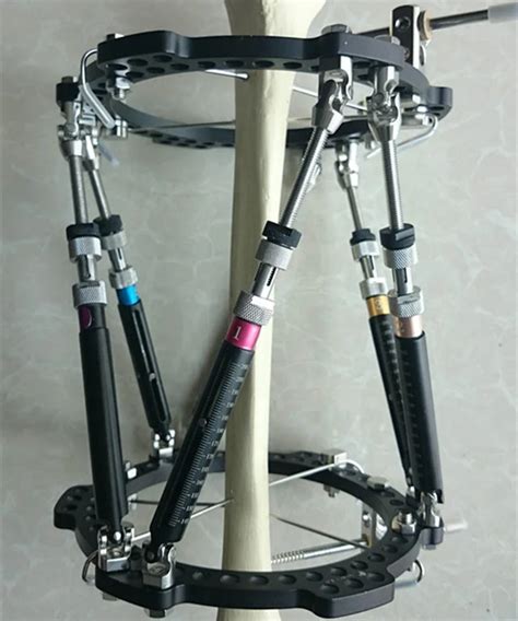 The Taylor Spatial Frame For External Fixation Buy The Taylor Spatial