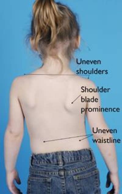Congenital Scoliosis Orthoinfo Aaos