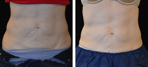 Before And After Lp Plastic Surgeon San Francisco Pacific Heights Plastic Surgery