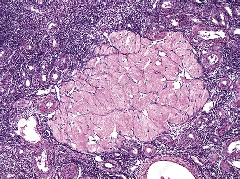 Ovary Human Corpus Albicans Lm Stock Image C Science