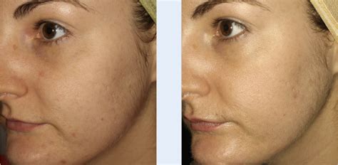 Before After Micro Needling For Acne Scarsn N N N