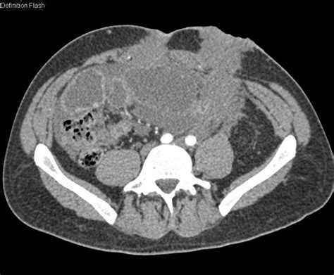 Carcinomatosis And Small Bowel Obstruction Sbo Due To Recurrent