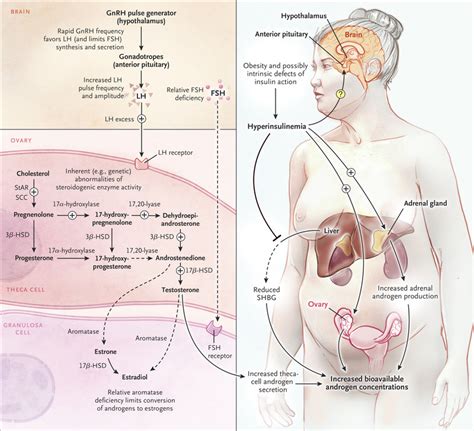 Polycystic Ovary Syndrome Nejm