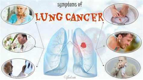 The most common symptoms of lung cancer are 10 Early Symptoms Of Lung Cancer In Men And Women