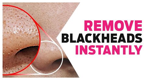 Get Rid Of Blackheads Easy Way To Remove Blackheads On Your Nose No