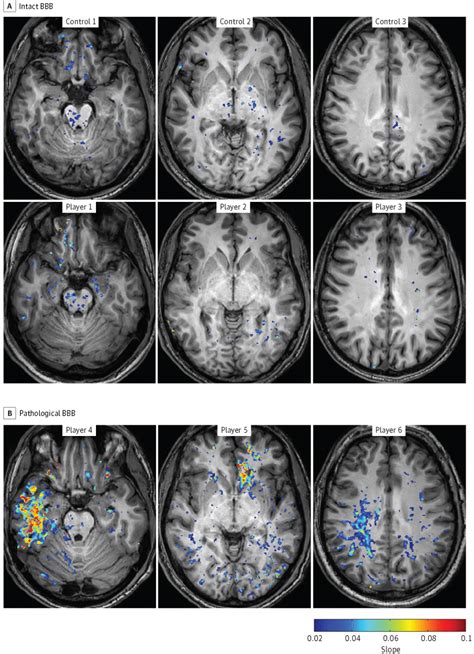 New documentary and book explore brain injuries and football. Football players found to have brain damage from mild ...