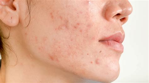 Acne Scars Causes Types Treatments And Prevention Tips Dr Praneeth