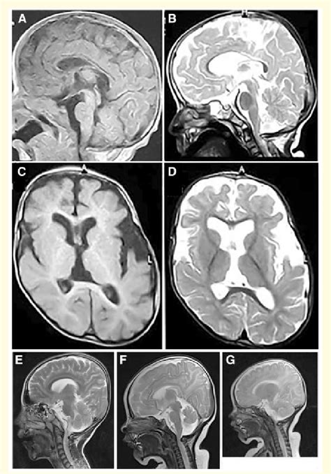 Brain Mri A D Case 3 Patient B Iv4 Sagittal T 1 And T 2 Cuts