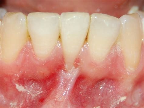Gum Grafting For Treatment Of Receding Gums In Vancouver Burnaby Bc