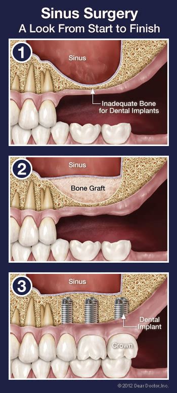 Wisdom Teeth Removal Complications Sinus