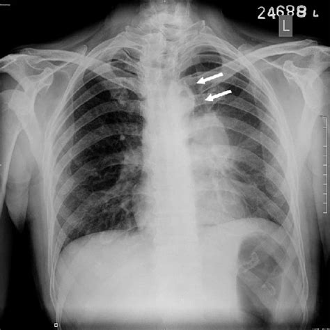 Chest Radiograph Of The Patient Reveals Left Hilar Shadow Left Lung