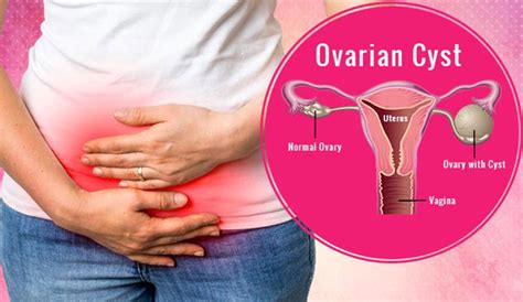 Ovarian Cysts Common Preventable Gynecologic Oncology Institute