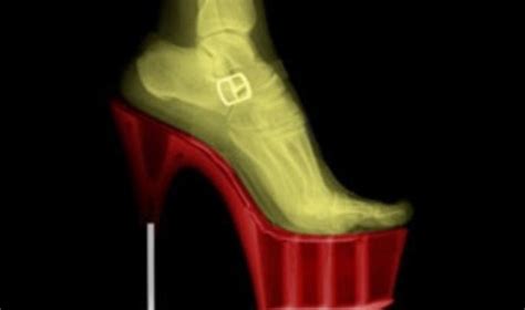 High Heels Causes Intense Pain And Foot Deformation In Most Women