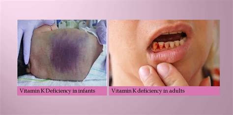 Vitamin K And Deficiency New