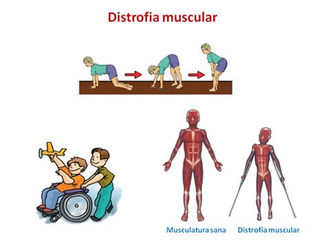 Distrofia Muscular Distrofia Muscular