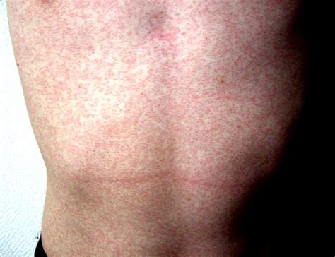 Allergy Medication For Skin Rash
