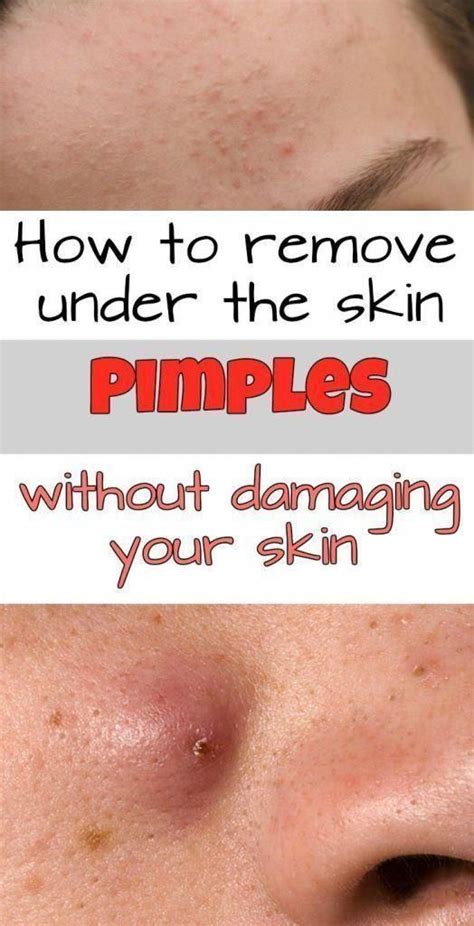 How To Remove Under The Skin Pimples Without Damaging Your Skin In 2020
