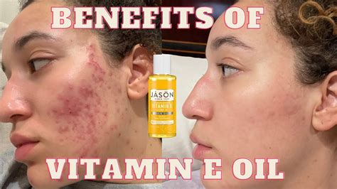 Vitamin E Oil For Acne Scarring Dry Andflaky Skin Arianna India