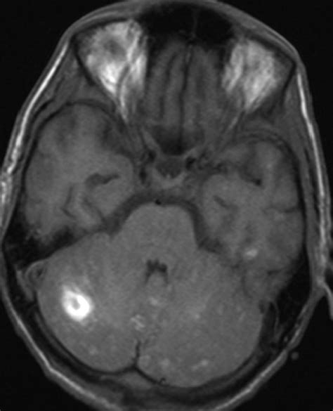 Unusual Extensive T1 Hyperintense Signals On Mr Imaging In
