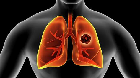Medical Illustration Of Lung Cancer Photograph By Stocktrek Images Pixels