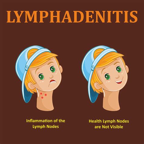 Lymph Nodes Swollen Lymph Nodes Locations Causes Signs Test Treatment