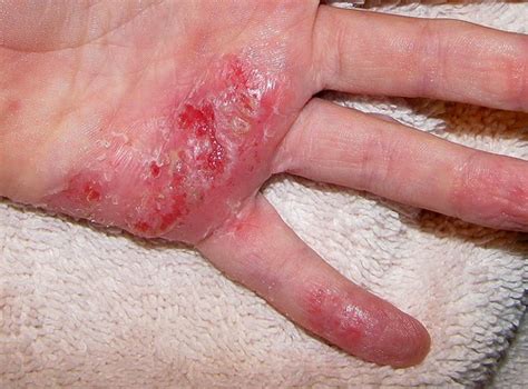 Skin Care Herpes Cold Sores Eczema