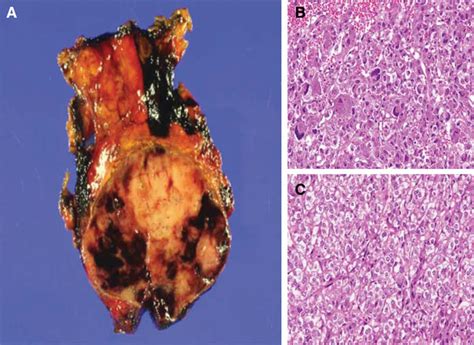 Case Of Chronic Indolent Pheochromocytoma That Caused Medically