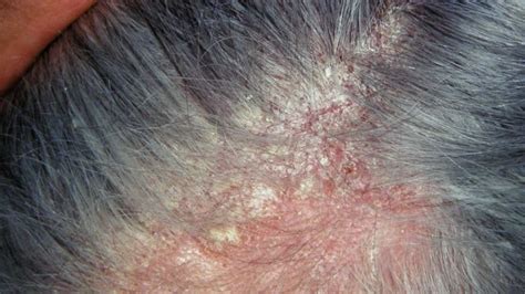 Dermatita Seboreica Cauze Simptome Diagnostic Si Tratament