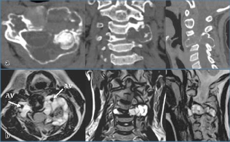 Ct And Mri Sections Of An Aneurysmal Bone Cyst Of The C4 Vertebra In A