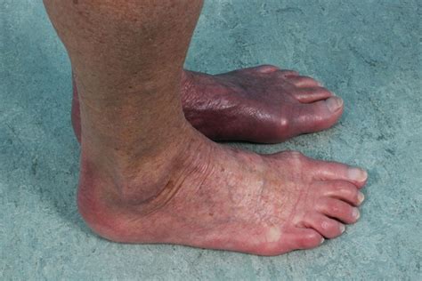 Asymmetric Red Bluish Foot Due To Acrodermatitis Chronica Atrophicans