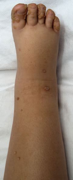 Primary Lymphedema And Viral Warts In Gata2 Haploinsufficiency Mayo