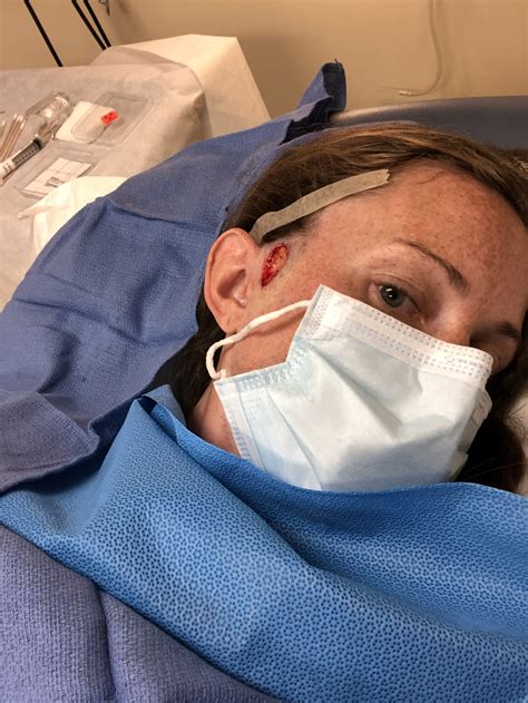 My Mohs Surgery Experience For Basal Cell Carcinoma Caitlin Houston