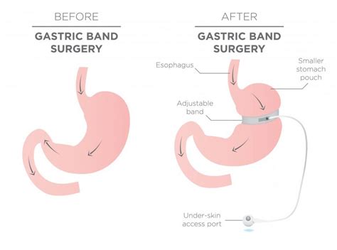 How Gastric Band Surgery Could Change Your Life Winnett Specialist Group