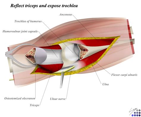 Posterior Approach To Elbow Approaches Orthobullets