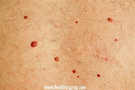 What Do The Red Moles On The Body Mean Healthzigzag
