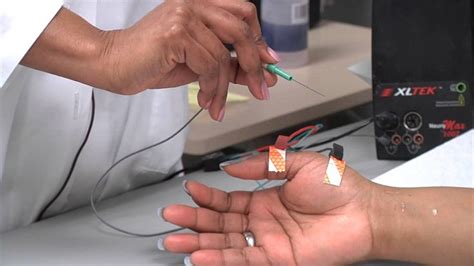 A Nerve Conduction Velocity Ncv Test Is The Medical Procedure That
